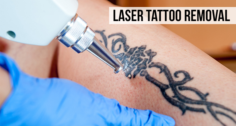 Tattoo Removal in Hyderabad  Best Laser Tattoo Removal Clinic Cost